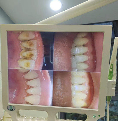 古德口腔洗牙中