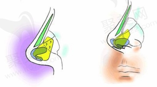杭州艺星张龙医生做鼻子技术优势
