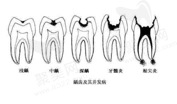 4岁宝宝牙齿腐蚀只剩牙根需要拔牙吗
