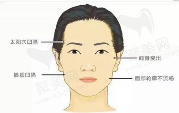 颧弓外扩是什么？