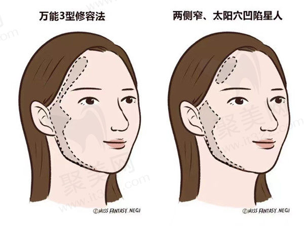 导致颧弓外扩的原因有哪些？