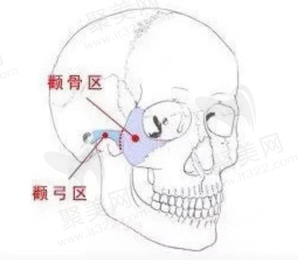 出现颧弓外扩应该怎么矫正