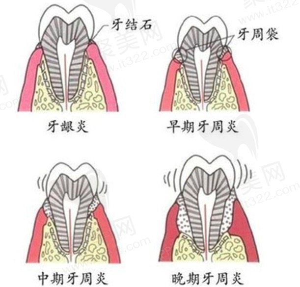 40岁牙周炎牙掉光了该怎么解决呢？
