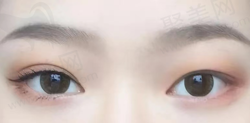 双眼皮至多可以修复几次