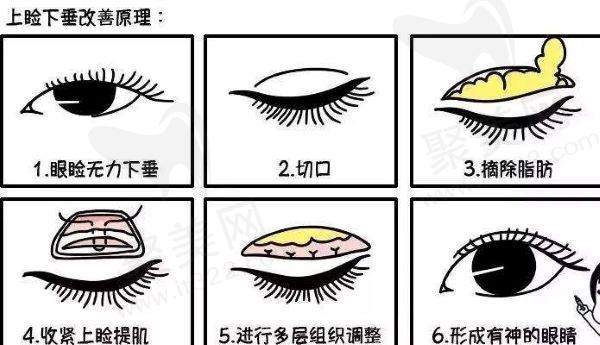 眼综合手术示意图