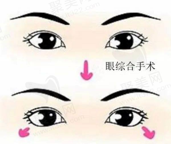 眼综合手术示意图