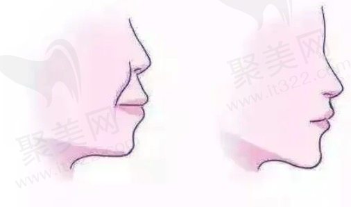 法令纹太深了怎么改善
