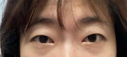 韩国清潭FIRST整形外科双眼皮修复