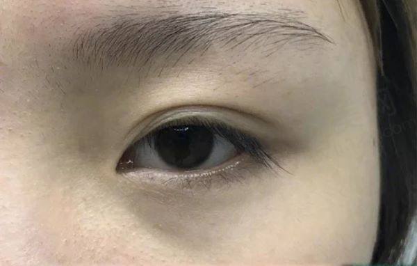 韩国欧佩拉整形医院眼修复