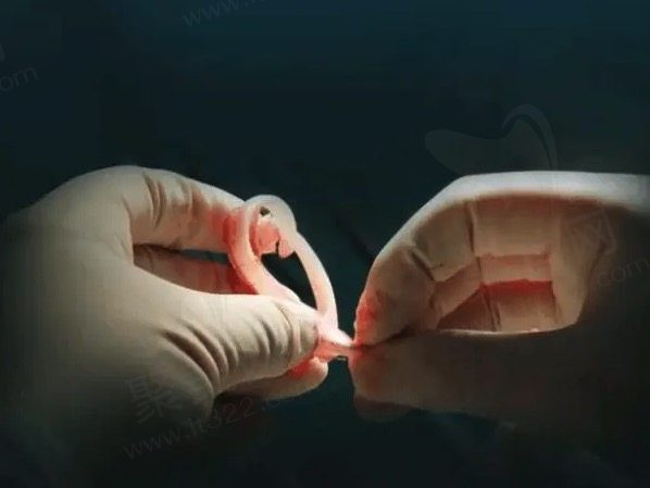 北京丽都郭志华耳再造使用生物材料