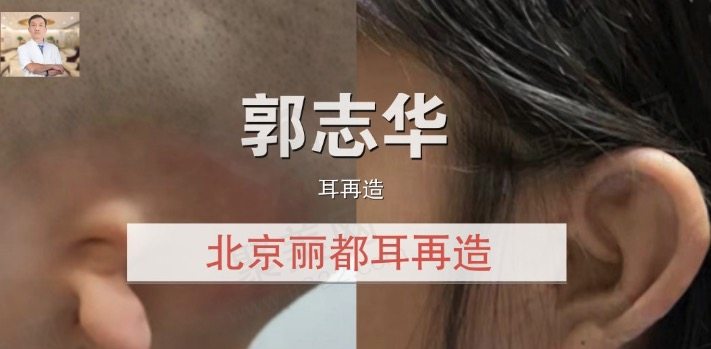 北京丽都郭志华耳再造患者的口碑与经验分享
