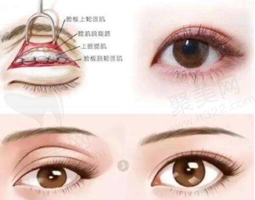 上海杜园园修复双眼皮多少钱