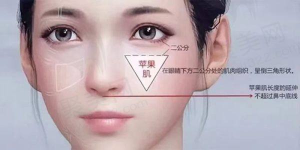 什么是苹果肌？