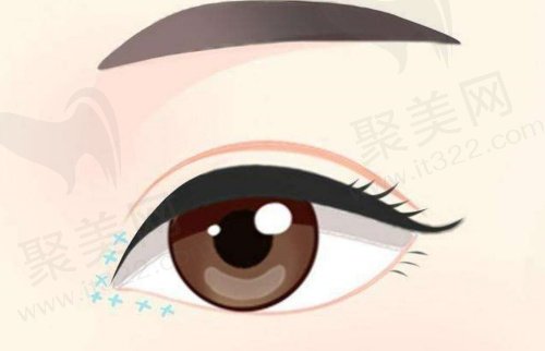 重庆军美胡金香做双眼皮技术优势