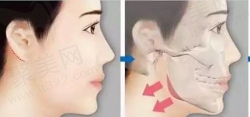 咬肌肥大和下颌角肥大的区别是什么