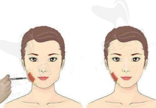 咬肌肥大怎么办