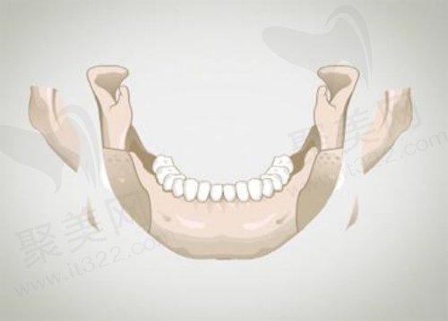 下颌角肥大怎么办