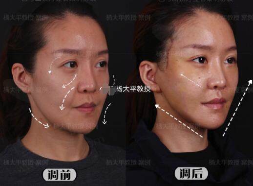 北京杨大平的面部提升切口位置