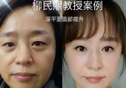 柳民熙拉皮手术做得好吗