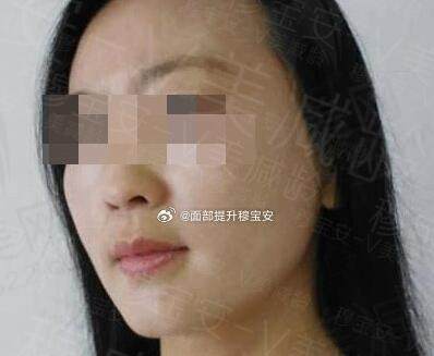 穆宝安拉皮做的怎么样