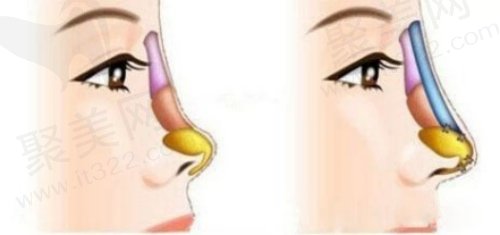 上海华美谢卫国做鼻子优势 上海华美谢卫国做鼻子优势