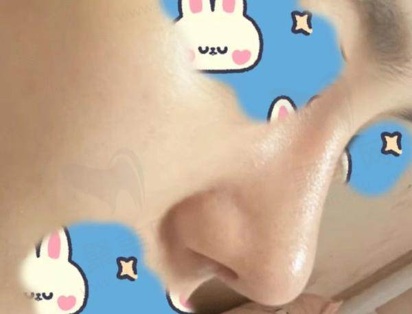 网友隆鼻评价1