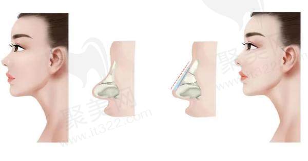韩国可来熙整形朴圣勋做鼻修复好在哪