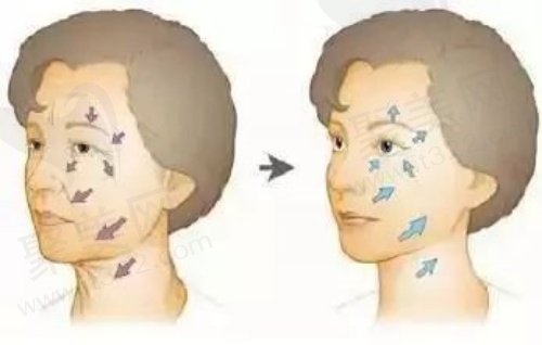 深圳拉皮手术多少钱