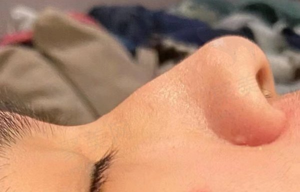 隆鼻评价