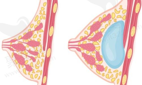 乳房假体取出手术费用花了3万多贵吗