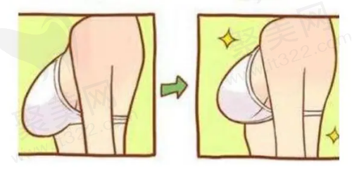 广州乳房假体取出手术价格