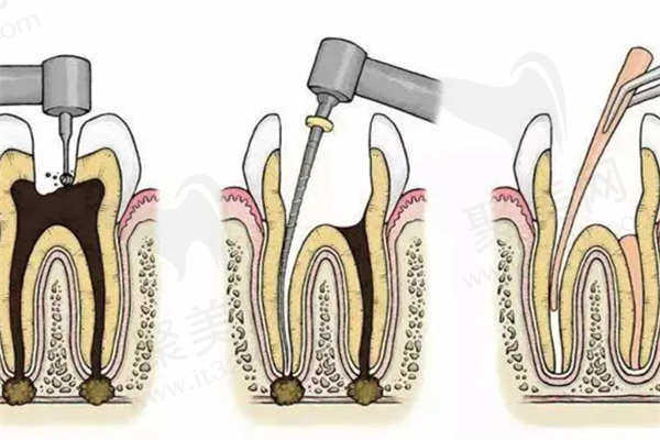 襄阳磨牙做根管治疗多少钱