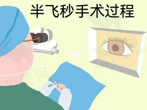 半飞秒激光好不好
