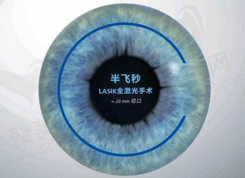 半飞秒激光手术怎么样