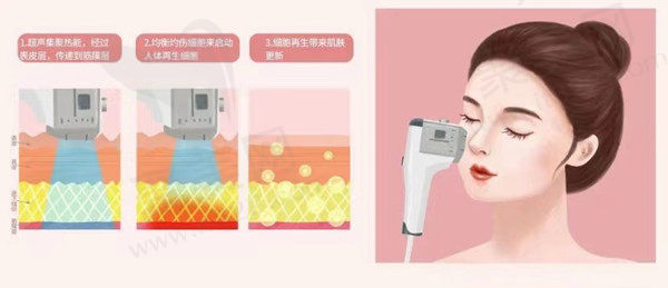 超声炮对去除法令纹有效吗？