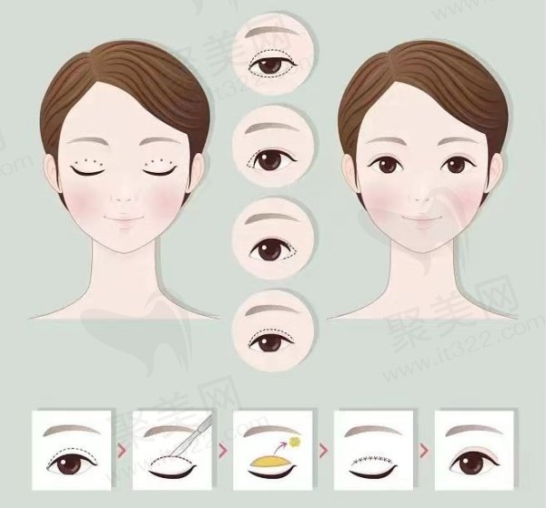 深圳艺星整形眼鼻整形价格