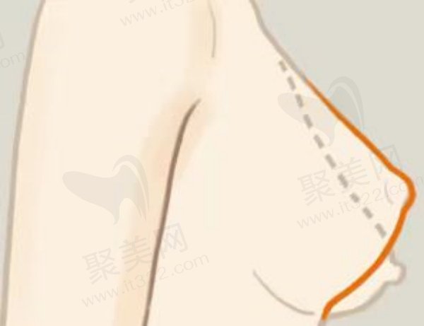 深圳艺星整形胸部整形价格