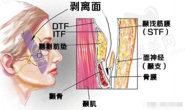 微拉美4.0提升是怎么做