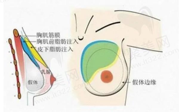 上海美莱唐毅隆胸口碑