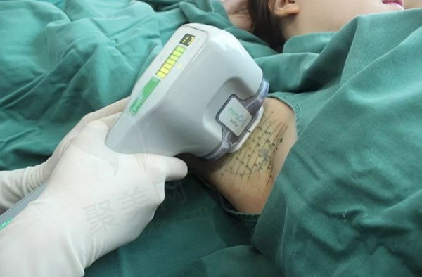 长沙美莱清新微波治疗腋臭技术怎么样