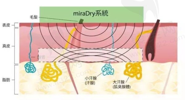 长沙美莱清新微波治疗腋臭医生推荐