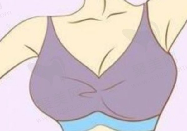 成都美莱吴江山假体隆胸优势