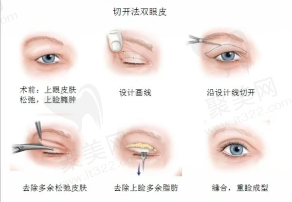 从网友真实评价可以看出赵医生做双眼皮备受欢迎