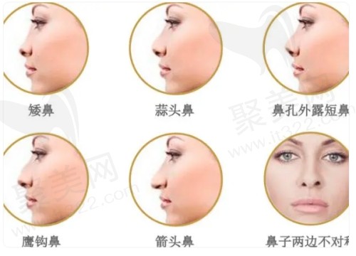 成都美莱黄小林隆鼻口碑