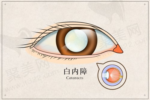 北京同仁白内障手术专 家哪个好？