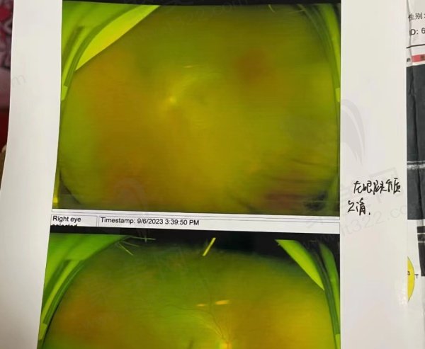 白内障手术评价