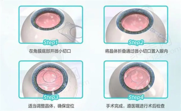 ticl晶体植入做了后度数还会上升吗？