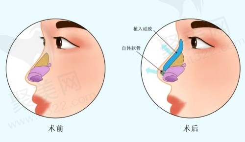 南京康美冯思阳做鼻子技术优势
