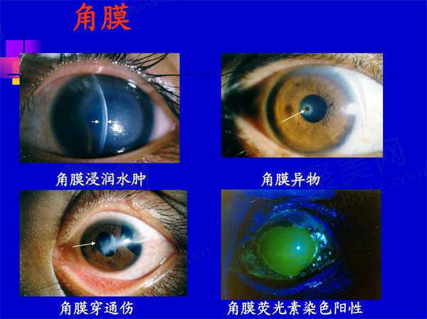 角膜移植需要排队等角膜吗？