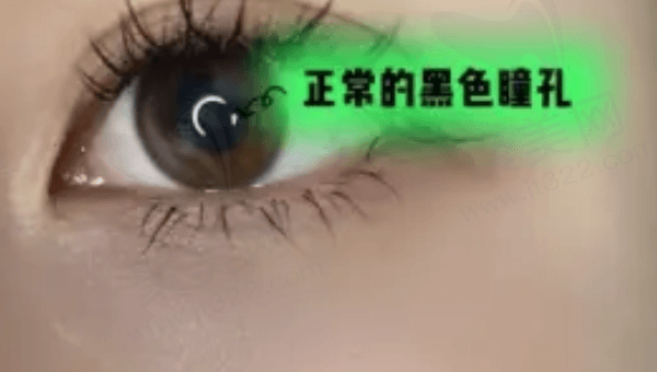 分享我在广州佰视佳眼科医院做了全飞秒手术的亲身感受
